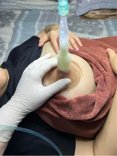 Phễu thủy tinh - bầu thủy tinh cho máy thông tắc tia sữa 