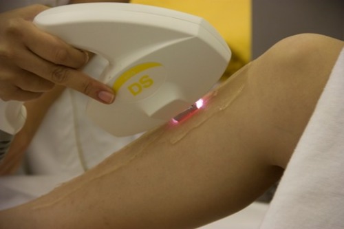 gel triệt lông vĩnh viễn